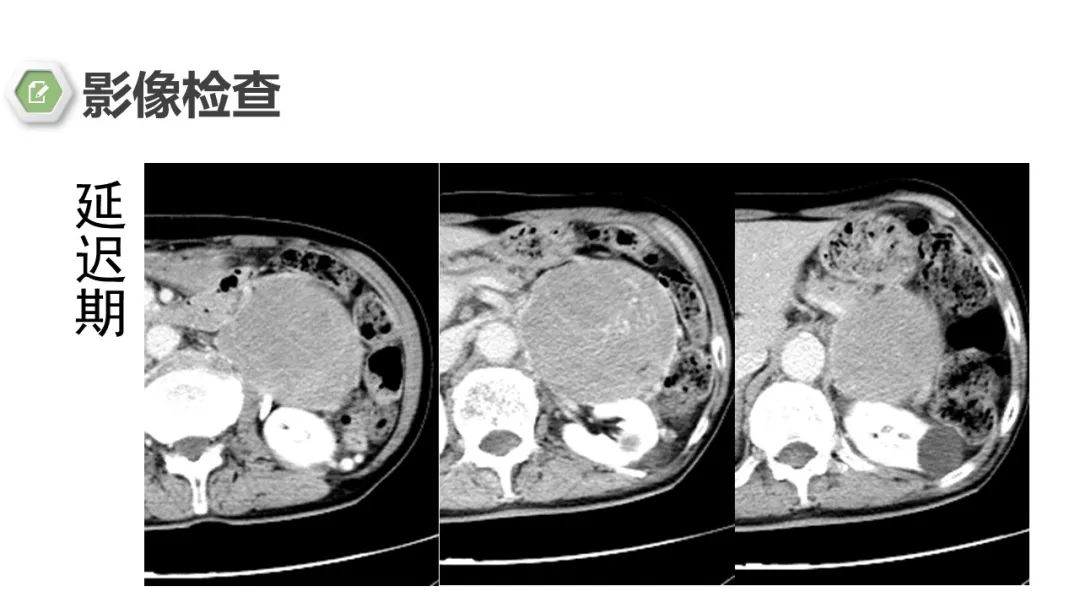 影像PPT - 【病例】肾上腺嗜铬细胞瘤1例CT影像-7 影像PPT - 【病例】肾上腺嗜铬细胞瘤1例CT影像-7