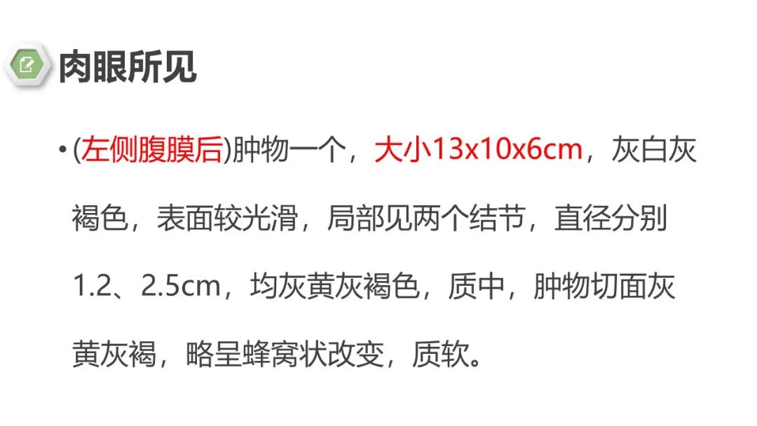 影像PPT - 【病例】肾上腺嗜铬细胞瘤1例CT影像-11 影像PPT - 【病例】肾上腺嗜铬细胞瘤1例CT影像-11
