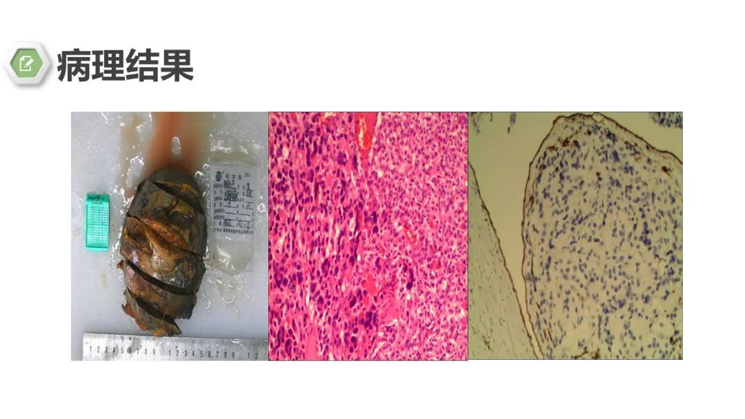 影像PPT - 【病例】肾上腺嗜铬细胞瘤1例CT影像-12 影像PPT - 【病例】肾上腺嗜铬细胞瘤1例CT影像-12