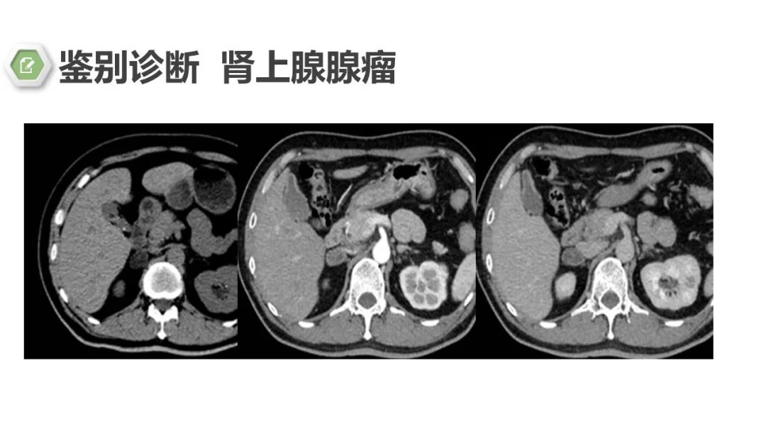 影像PPT - 【病例】肾上腺嗜铬细胞瘤1例CT影像-20 影像PPT - 【病例】肾上腺嗜铬细胞瘤1例CT影像-20