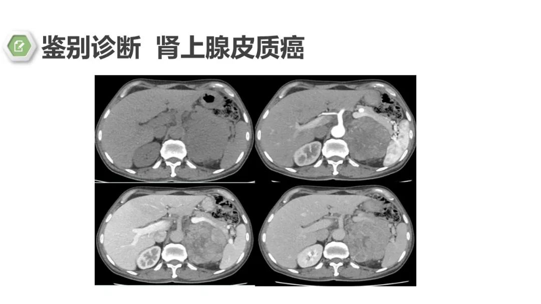 影像PPT - 【病例】肾上腺嗜铬细胞瘤1例CT影像-23 影像PPT - 【病例】肾上腺嗜铬细胞瘤1例CT影像-23