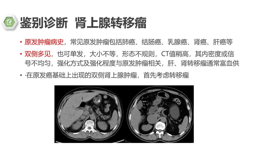 影像PPT - 【病例】肾上腺嗜铬细胞瘤1例CT影像-24 影像PPT - 【病例】肾上腺嗜铬细胞瘤1例CT影像-24