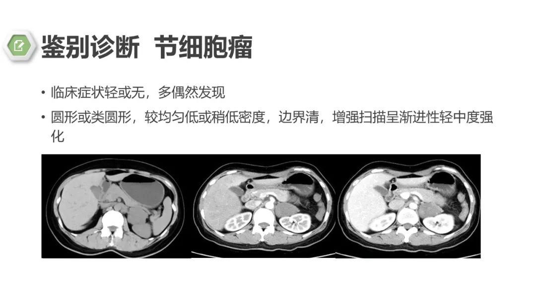 影像PPT - 【病例】肾上腺嗜铬细胞瘤1例CT影像-25 影像PPT - 【病例】肾上腺嗜铬细胞瘤1例CT影像-25