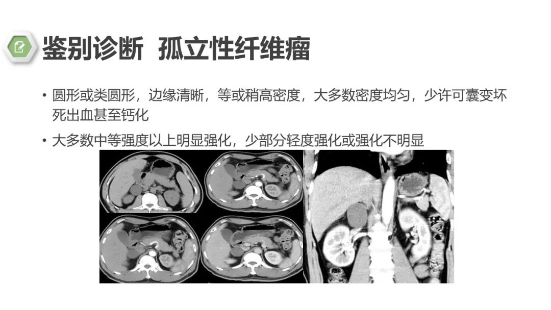 影像PPT - 【病例】肾上腺嗜铬细胞瘤1例CT影像-26 影像PPT - 【病例】肾上腺嗜铬细胞瘤1例CT影像-26