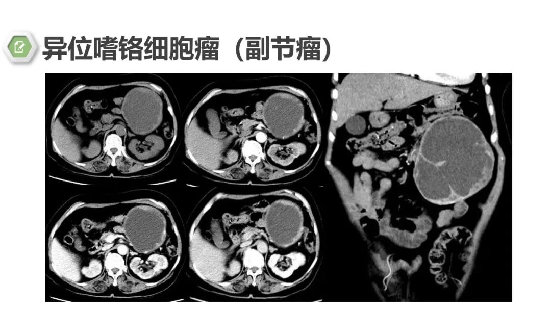 影像PPT - 【病例】肾上腺嗜铬细胞瘤1例CT影像-28 影像PPT - 【病例】肾上腺嗜铬细胞瘤1例CT影像-28