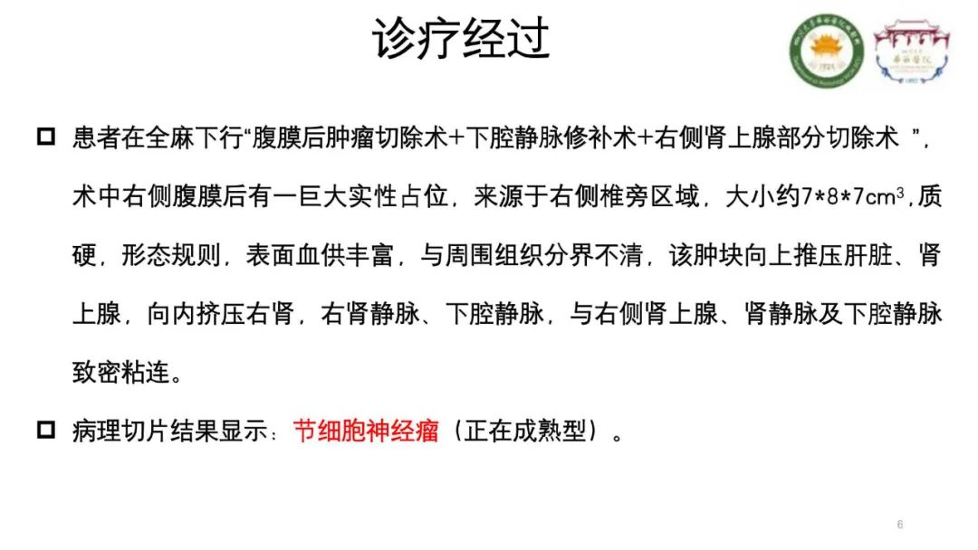 影像PPT - 【病例】腹膜后节细胞神经瘤1例CT影像-6