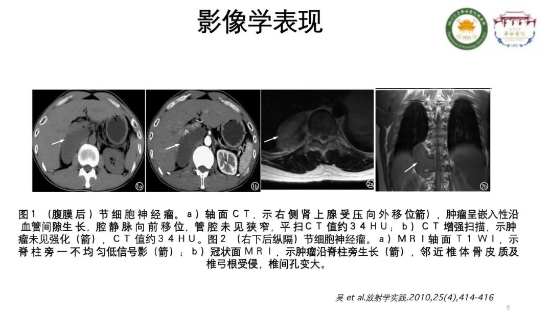 影像PPT - 【病例】腹膜后节细胞神经瘤1例CT影像-9