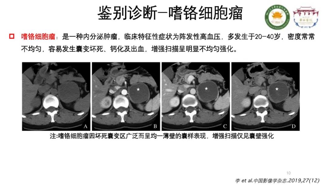 影像PPT - 【病例】腹膜后节细胞神经瘤1例CT影像-10