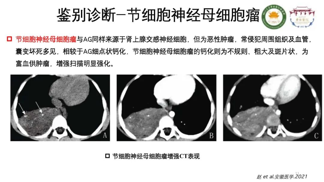 影像PPT - 【病例】腹膜后节细胞神经瘤1例CT影像-11