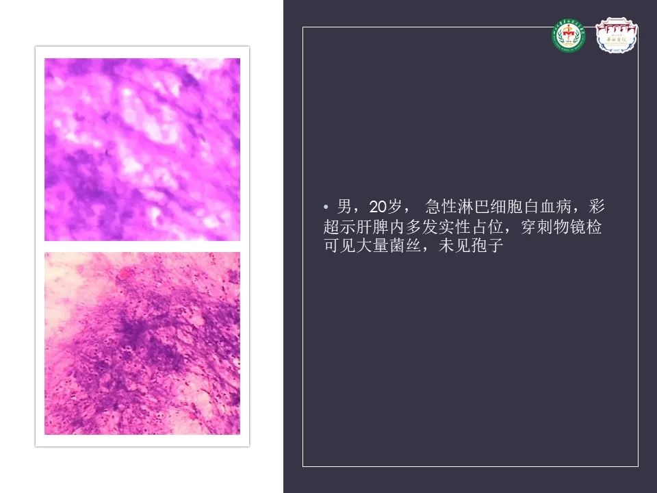影像PPT - 【病例】肝脏念珠菌病1例CT影像-16