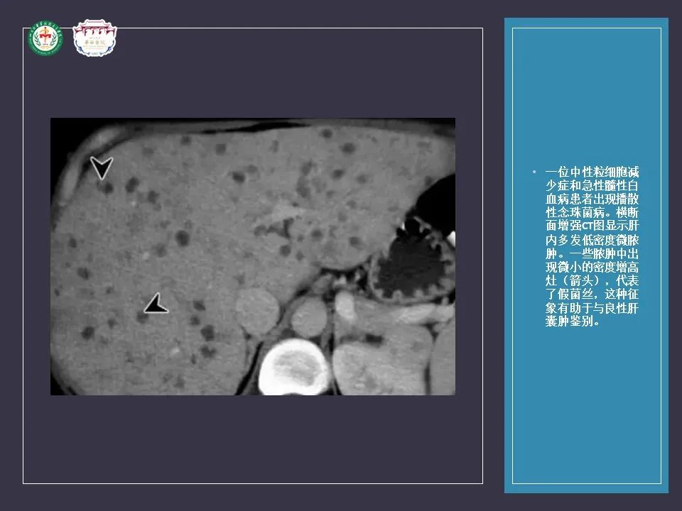 影像PPT - 【病例】肝脏念珠菌病1例CT影像-19