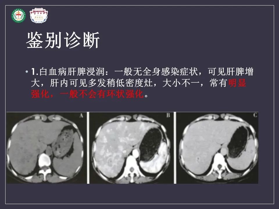 影像PPT - 【病例】肝脏念珠菌病1例CT影像-21