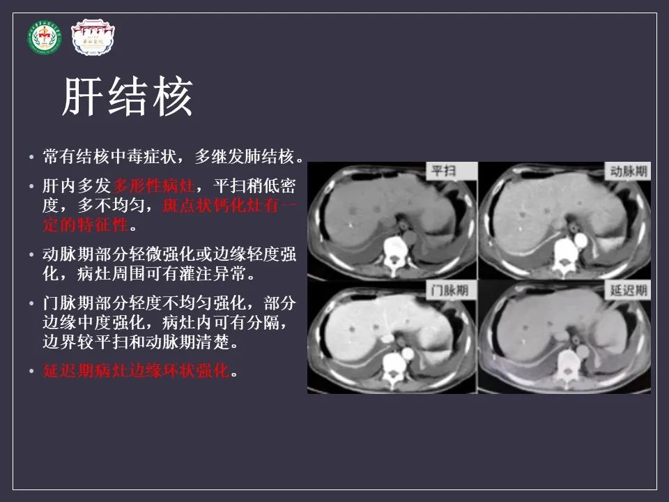 影像PPT - 【病例】肝脏念珠菌病1例CT影像-22