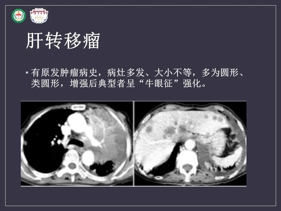 影像PPT - 【病例】肝脏念珠菌病1例CT影像-23