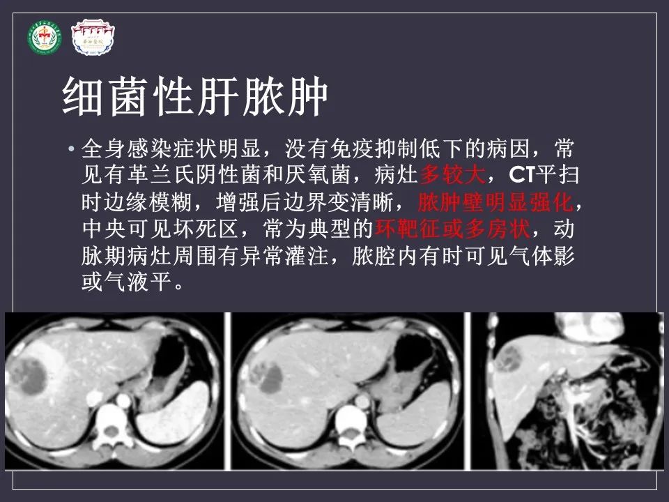 影像PPT - 【病例】肝脏念珠菌病1例CT影像-24