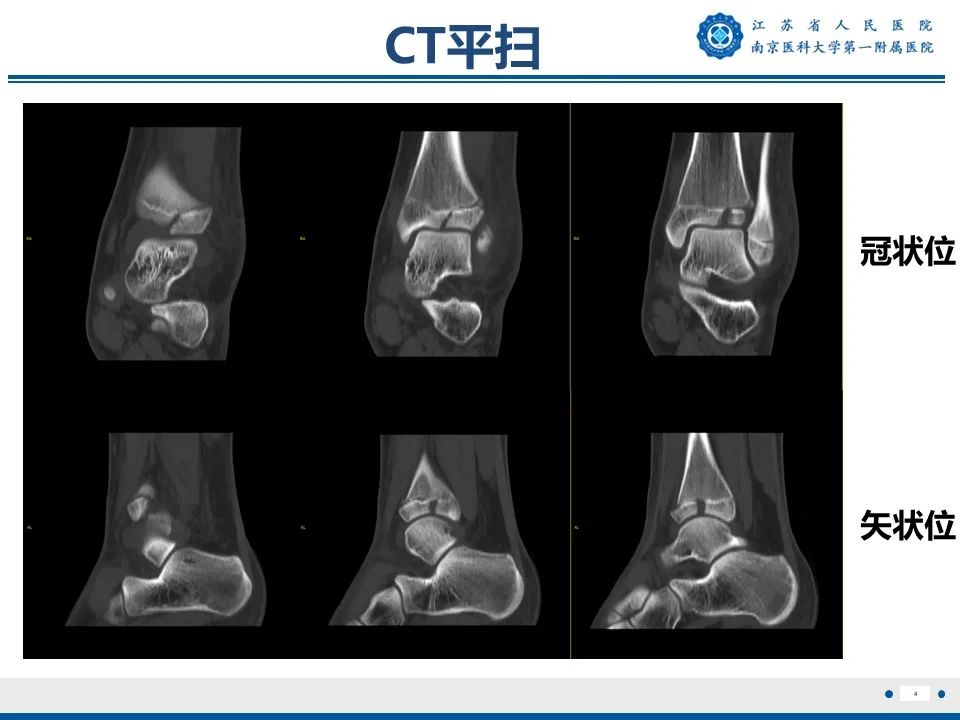 影像PPT - 【PPT】Tillaux骨折-5