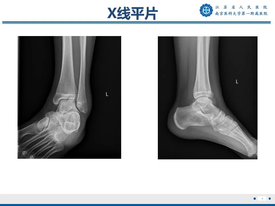 影像PPT - 【PPT】Tillaux骨折-3