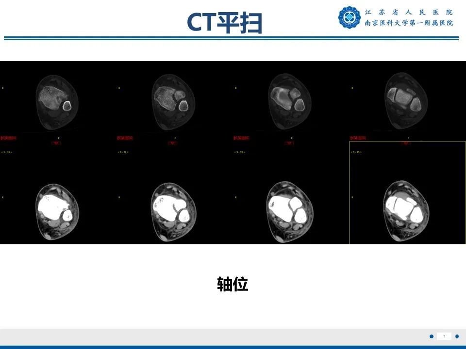 影像PPT - 【PPT】Tillaux骨折-4