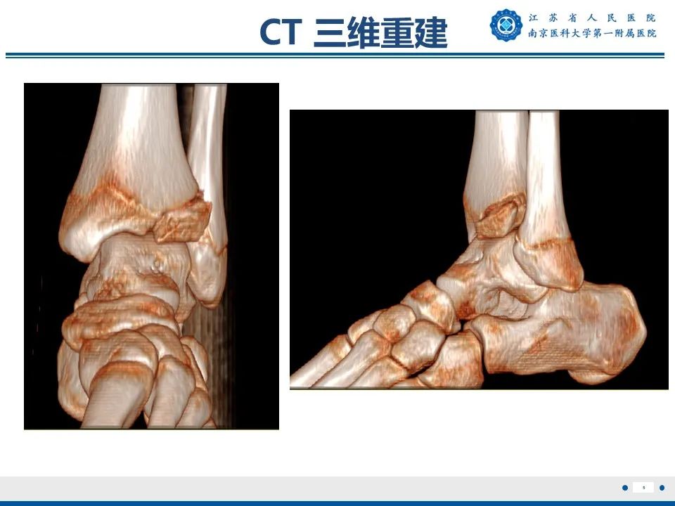 影像PPT - 【PPT】Tillaux骨折-6