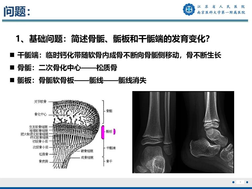 影像PPT - 【PPT】Tillaux骨折-8