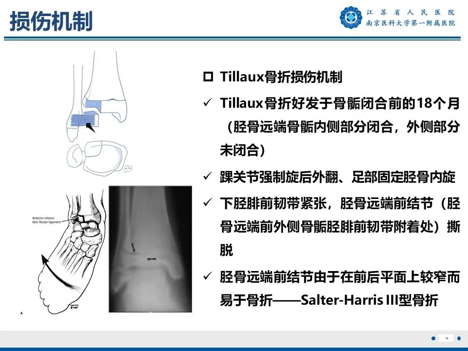 影像PPT - 【PPT】Tillaux骨折-15