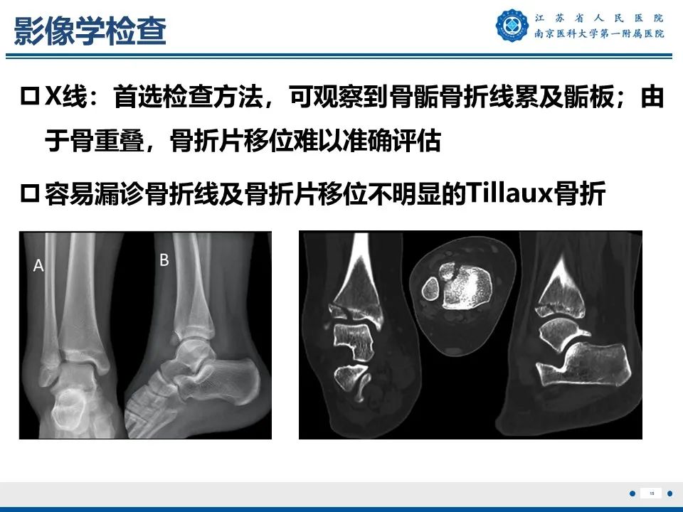 影像PPT - 【PPT】Tillaux骨折-16