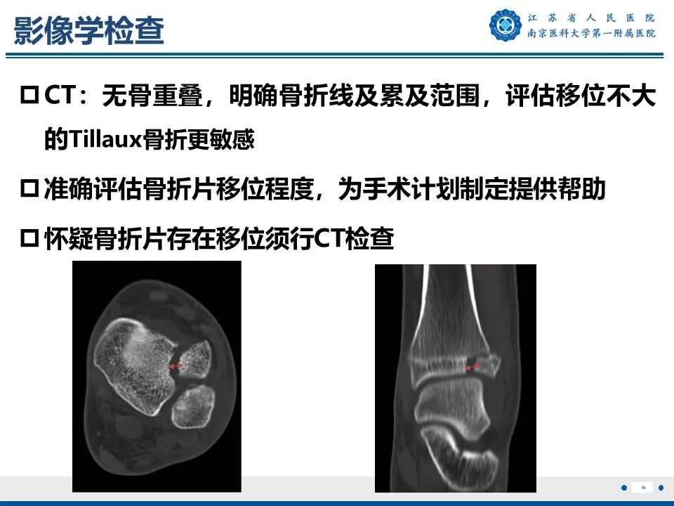 影像PPT - 【PPT】Tillaux骨折-17