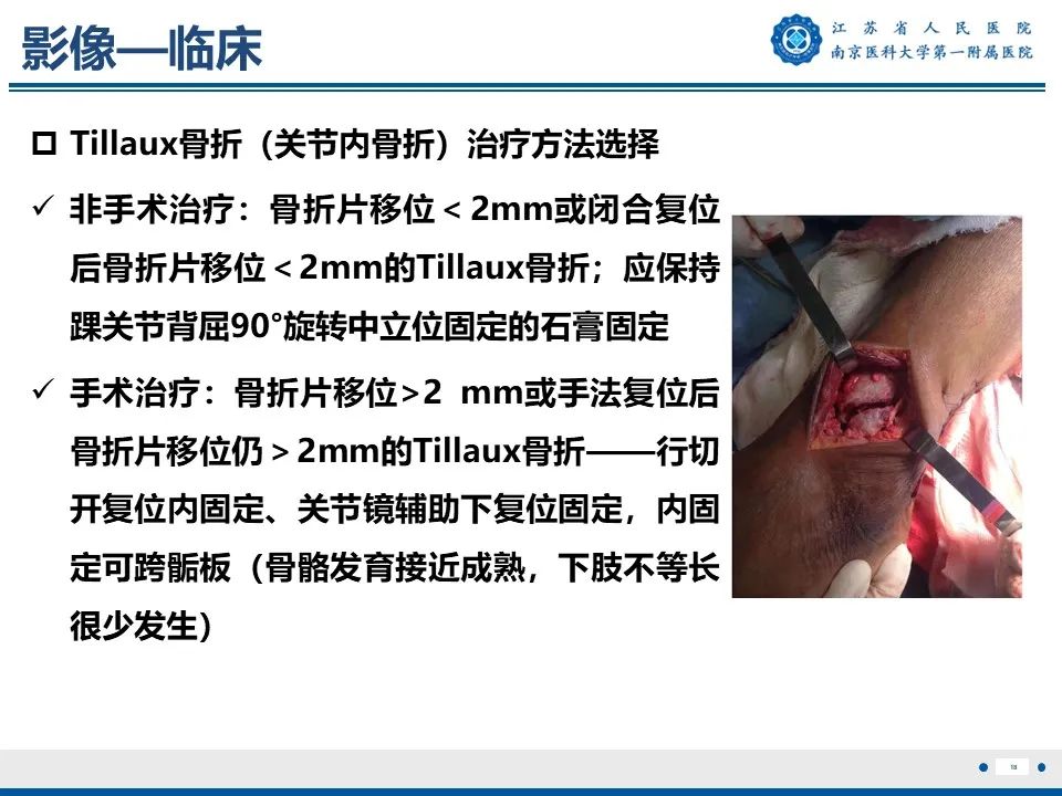 影像PPT - 【PPT】Tillaux骨折-19