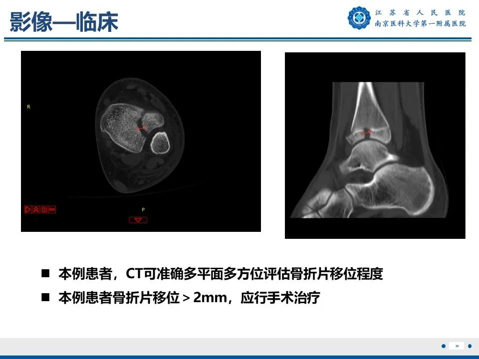 影像PPT - 【PPT】Tillaux骨折-21