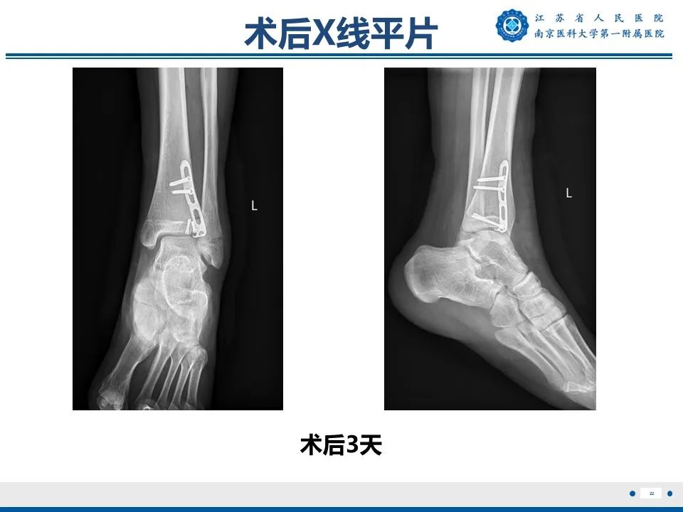 影像PPT - 【PPT】Tillaux骨折-23