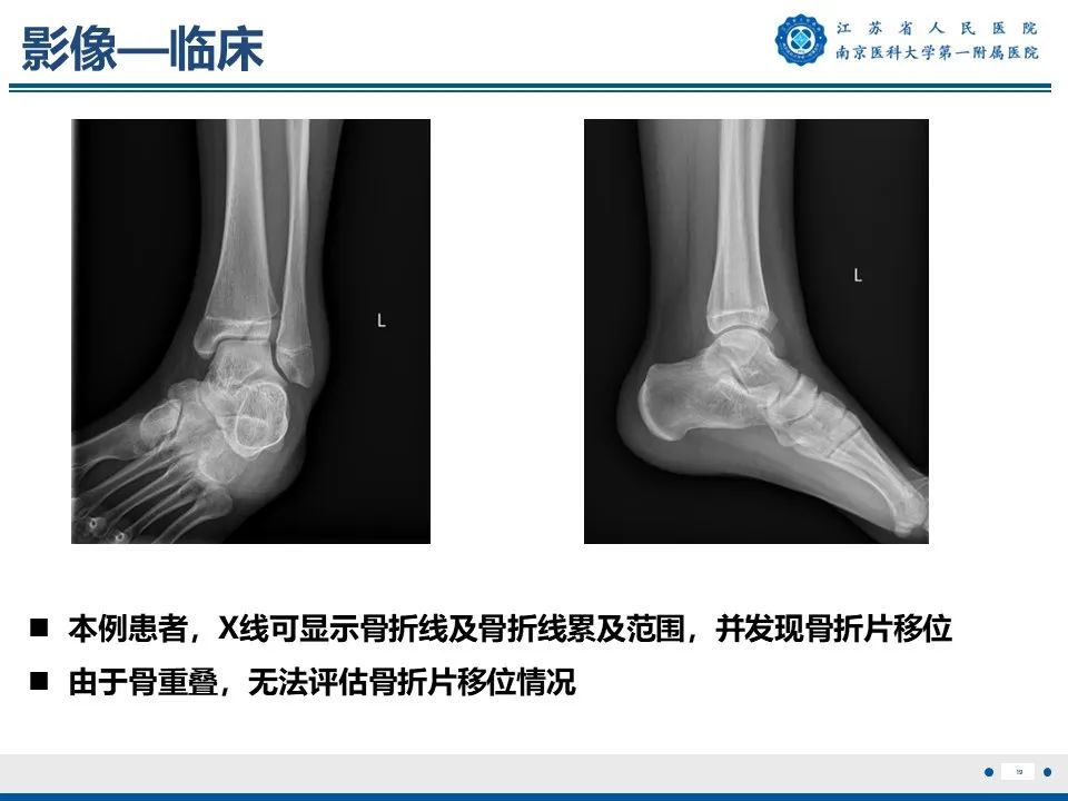 影像PPT - 【PPT】Tillaux骨折-20