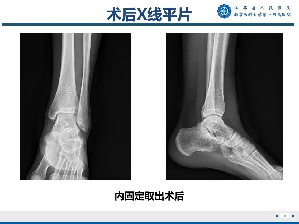 影像PPT - 【PPT】Tillaux骨折-24