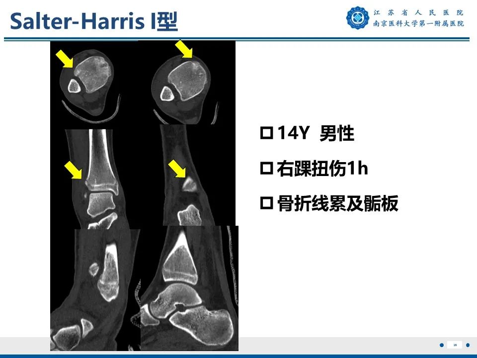 影像PPT - 【PPT】Tillaux骨折-27