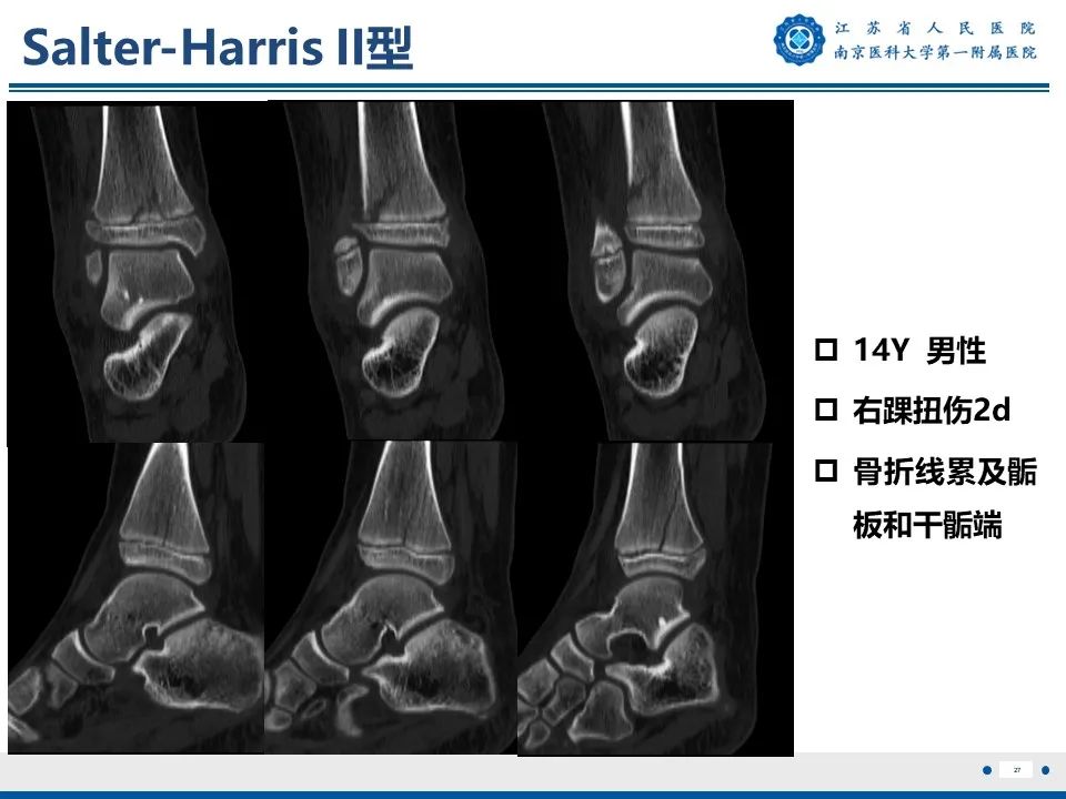 影像PPT - 【PPT】Tillaux骨折-28