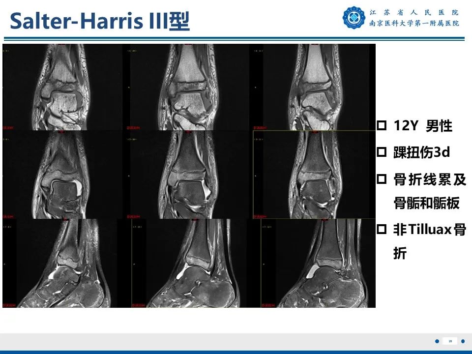 影像PPT - 【PPT】Tillaux骨折-29