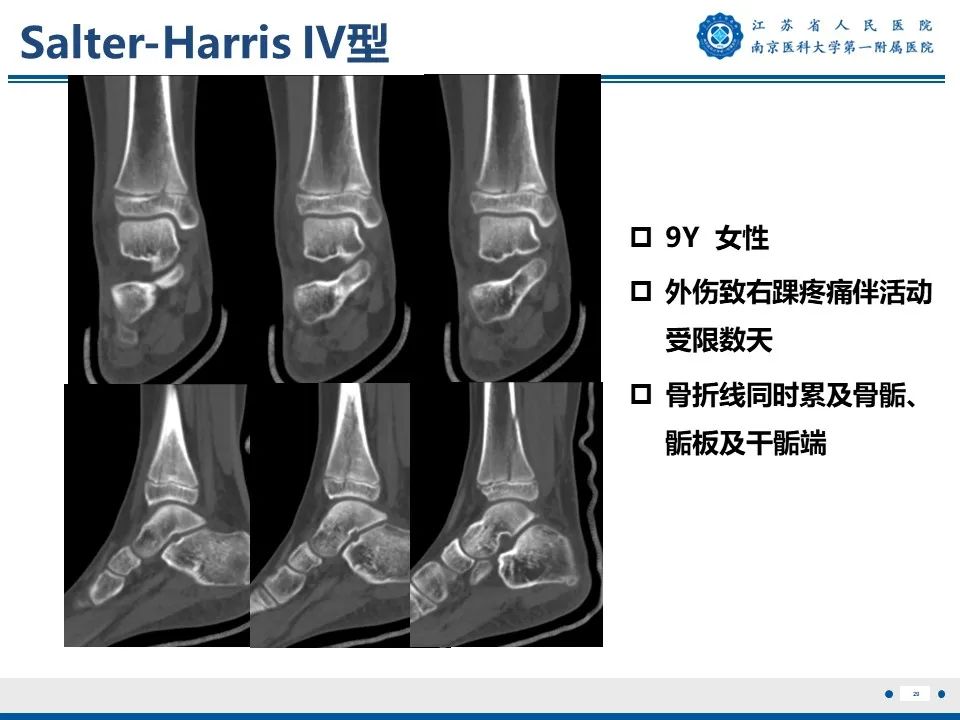 影像PPT - 【PPT】Tillaux骨折-30