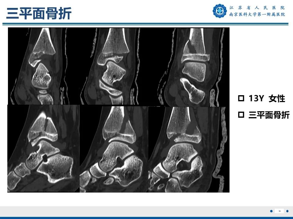 影像PPT - 【PPT】Tillaux骨折-33