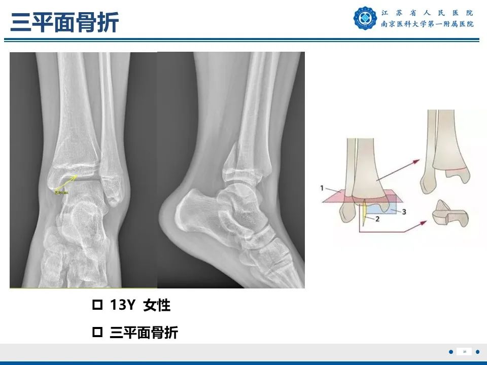 影像PPT - 【PPT】Tillaux骨折-32