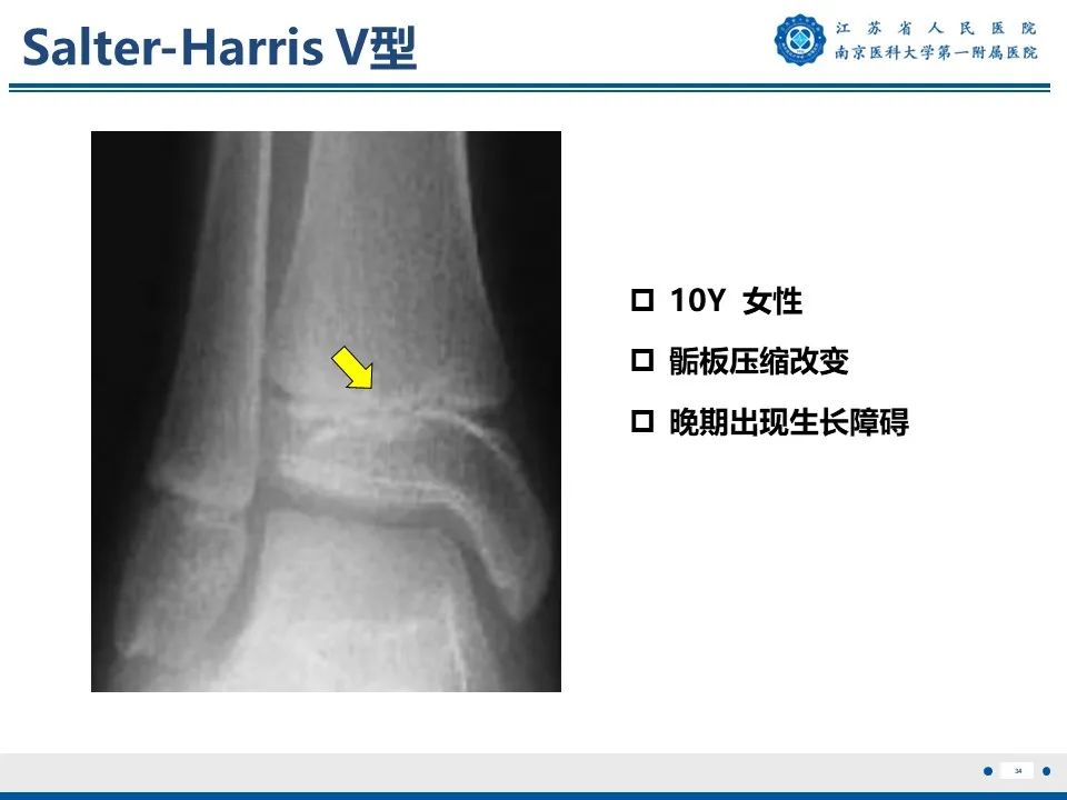 影像PPT - 【PPT】Tillaux骨折-35