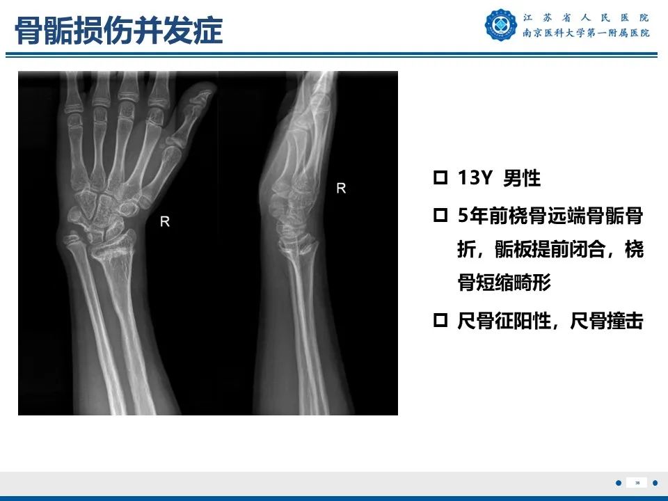 影像PPT - 【PPT】Tillaux骨折-37