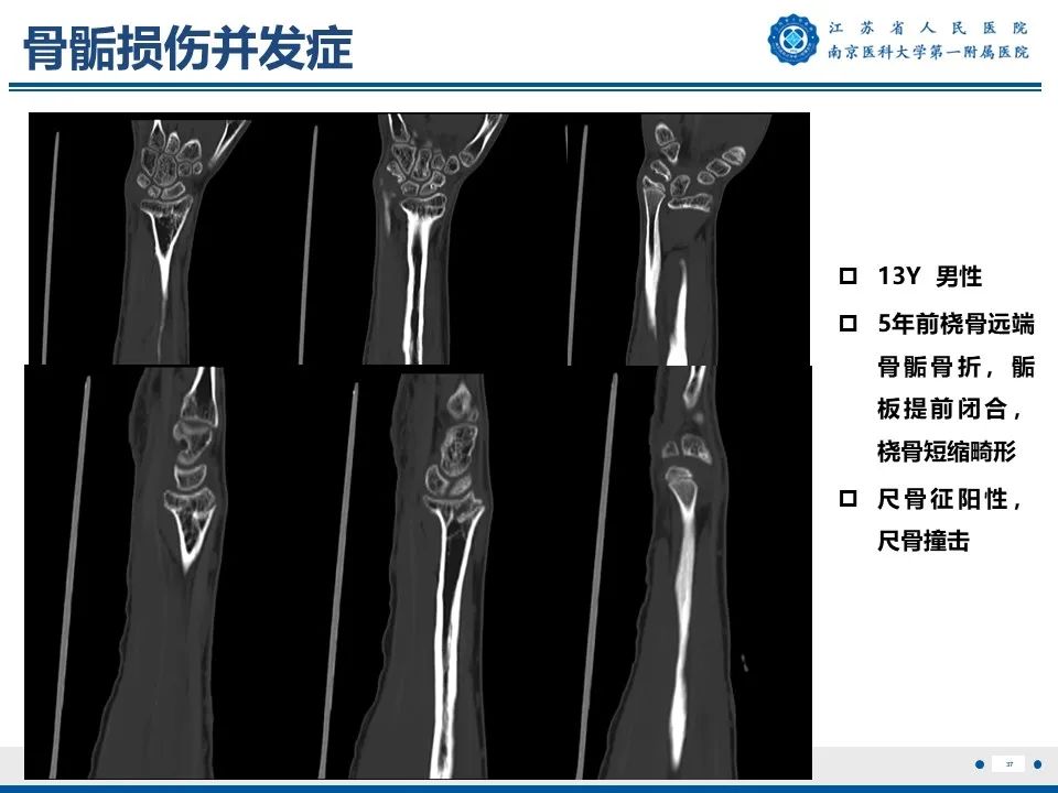 影像PPT - 【PPT】Tillaux骨折-38