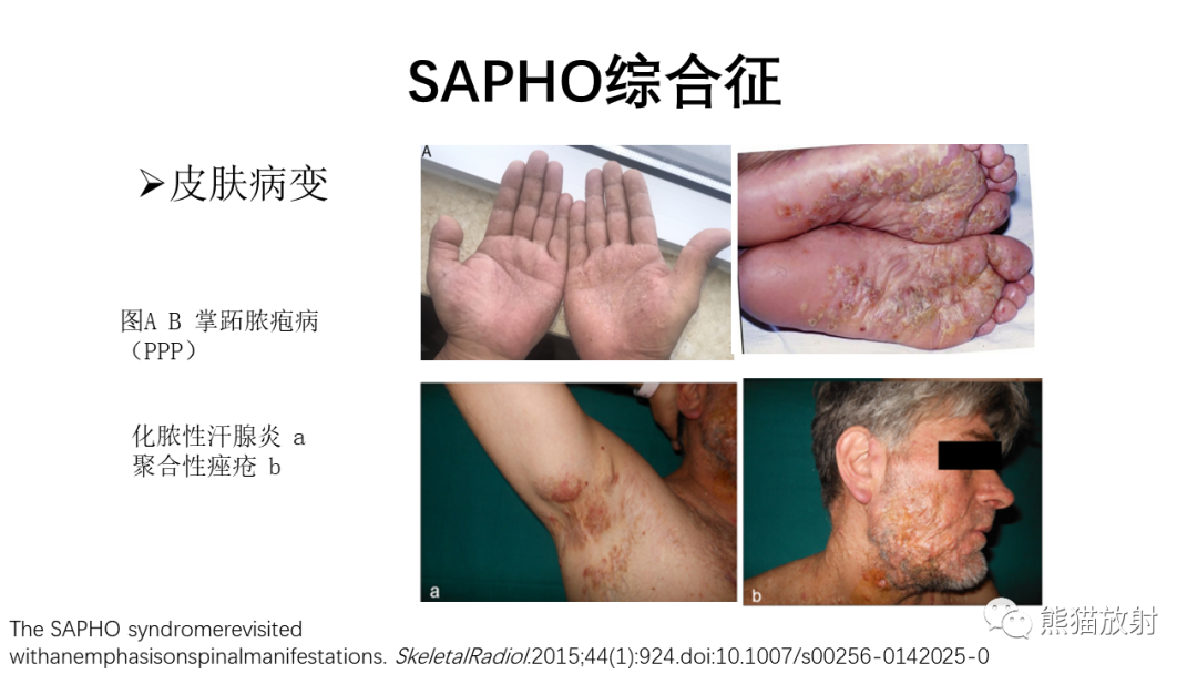 影像PPT - 【病例】SAPHO综合征2例CT及MR影像-21