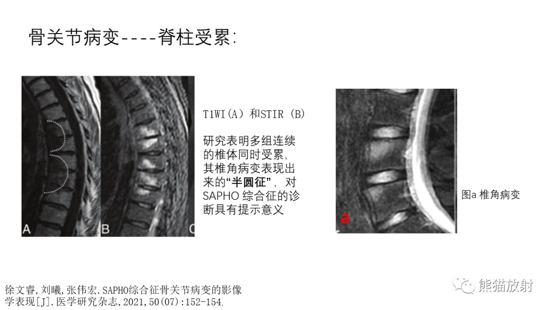 影像PPT - 【病例】SAPHO综合征2例CT及MR影像-28
