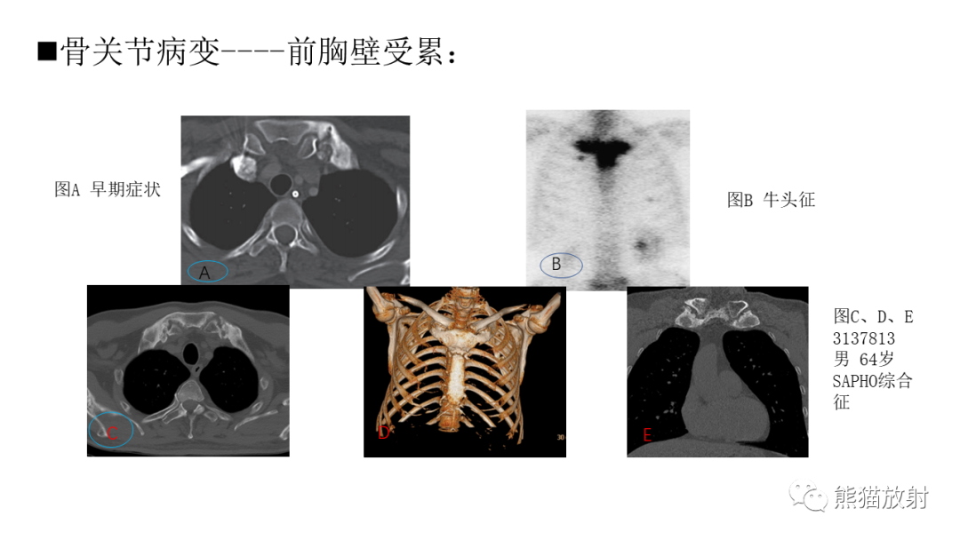 影像PPT - 【病例】SAPHO综合征2例CT及MR影像-25