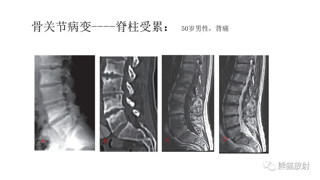 影像PPT - 【病例】SAPHO综合征2例CT及MR影像-29