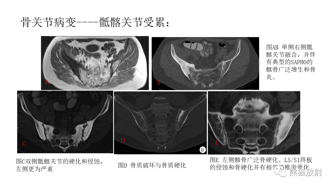 影像PPT - 【病例】SAPHO综合征2例CT及MR影像-31