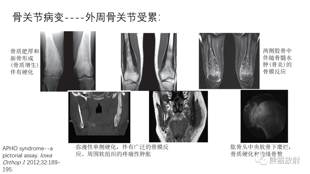 影像PPT - 【病例】SAPHO综合征2例CT及MR影像-33
