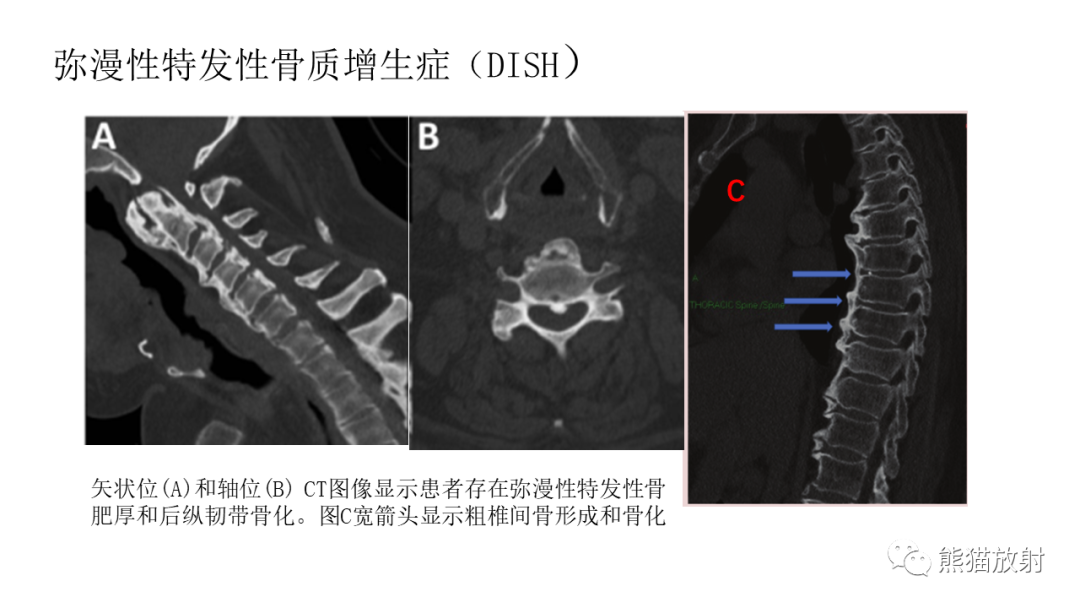 影像PPT - 【病例】SAPHO综合征2例CT及MR影像-37
