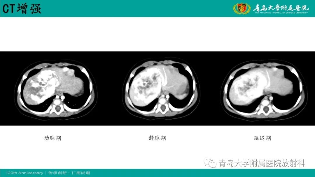 影像PPT - 【病例】婴儿型肝血管内皮细胞瘤2例CT影像-3