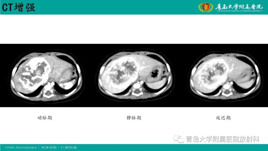影像PPT - 【病例】婴儿型肝血管内皮细胞瘤2例CT影像-4